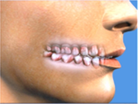 occlusione